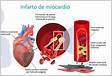 Teste rápido Características clínicas do infarto do miocárdi